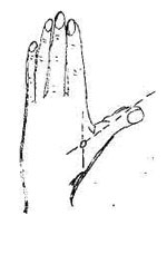 Рис. 2. Головная боль (мигрень) migren